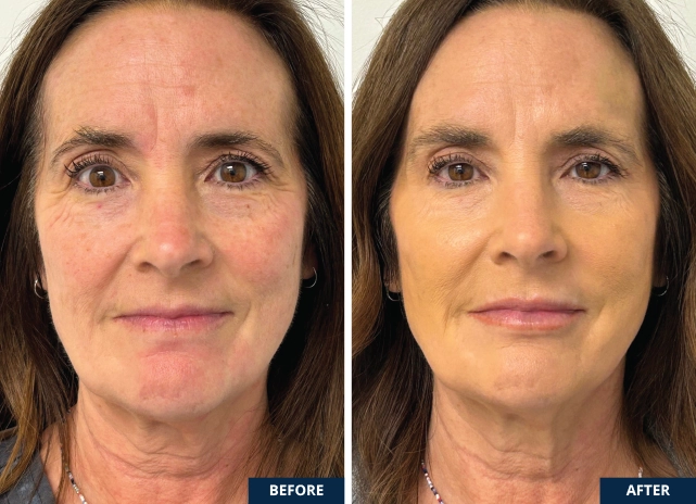 botox-hyaluronic-acid-cheeks-lips