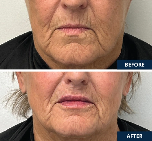 botox-lip-filler-Radiesse-Voluma