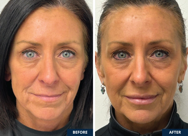 botox-radiesse-hyaluronic-acid-lips