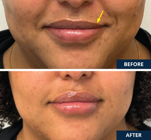 lip-asymmetry-correction