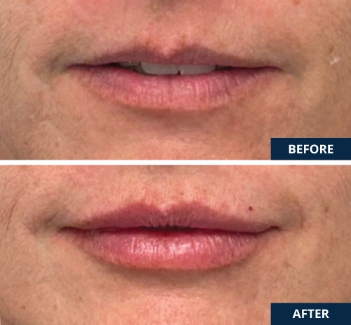before and after of Lip Filler procedure