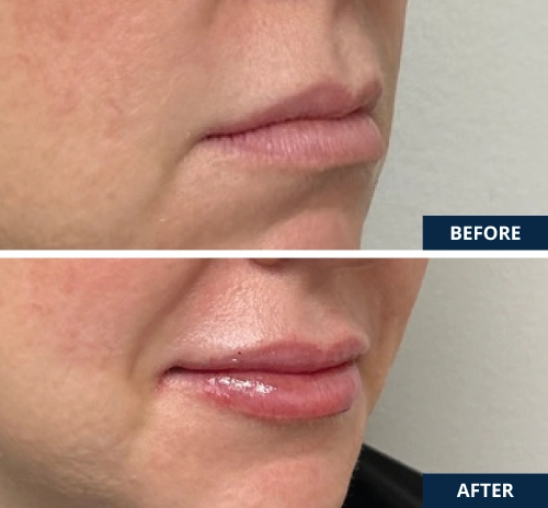 lip-filler-02