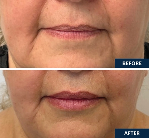 lip-filler-04