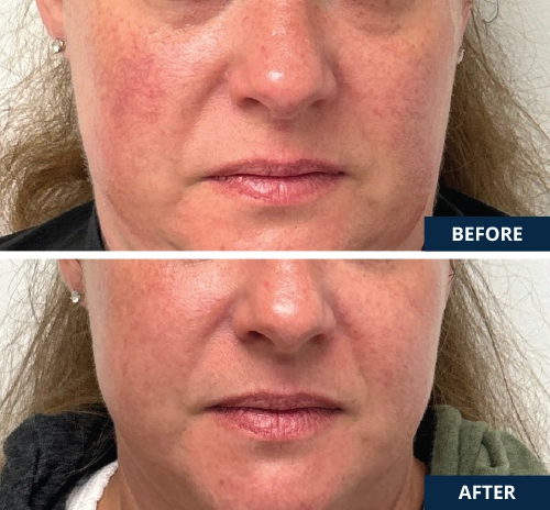 microbotox-and-laser-01