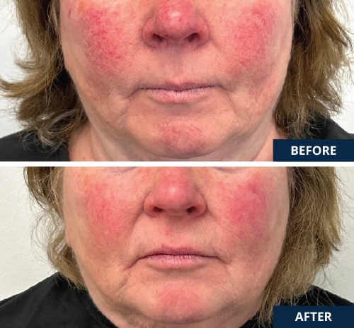 microbotox-and-laser-02